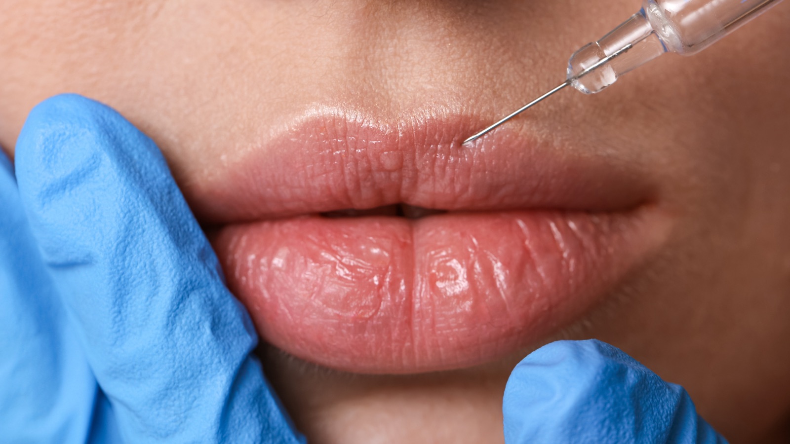 Aplicação profissional de botox e preenchimento facial em paciente da Dra. Ana Cláudia Rabelo