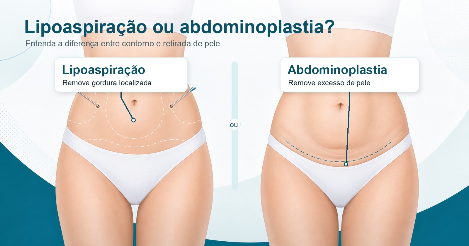 lipoaspiração ou abdominoplastia
